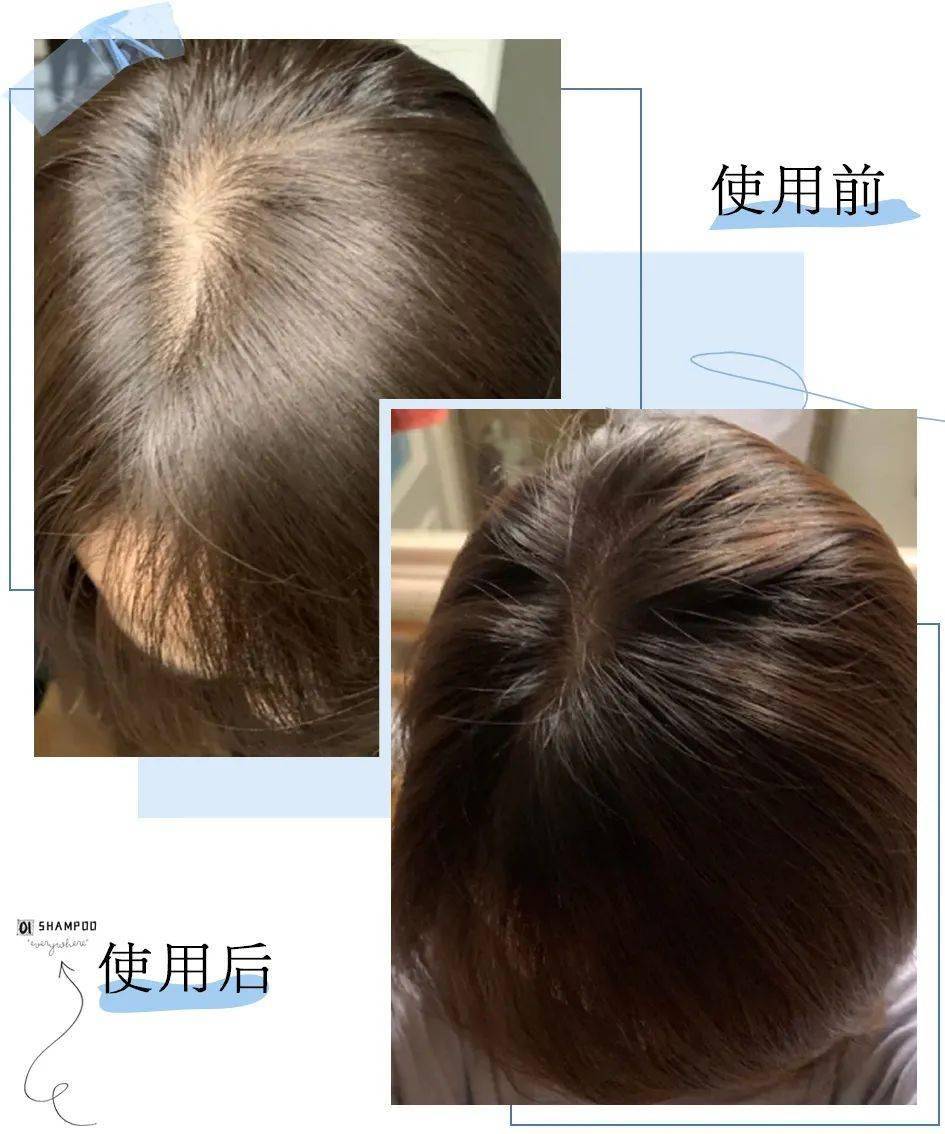 头上抠下的白泥居然不是头皮屑脱发头油都是因为它