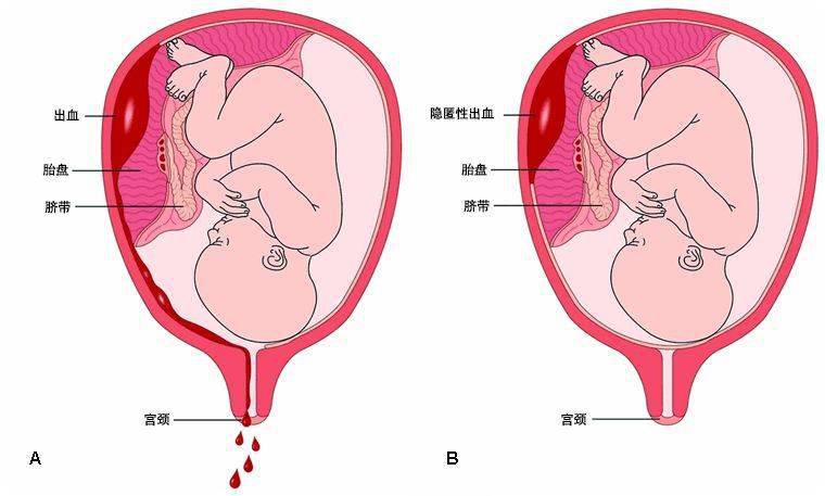 怀孕初期子宫图片