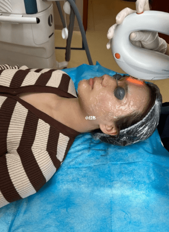 壹点主播闺蜜团体验|记录一次打m22光子嫩肤的真实体验