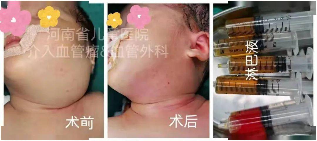 胎里带来的瘤,让宝妈差点想要放弃!_丁语_淋巴管_孩子