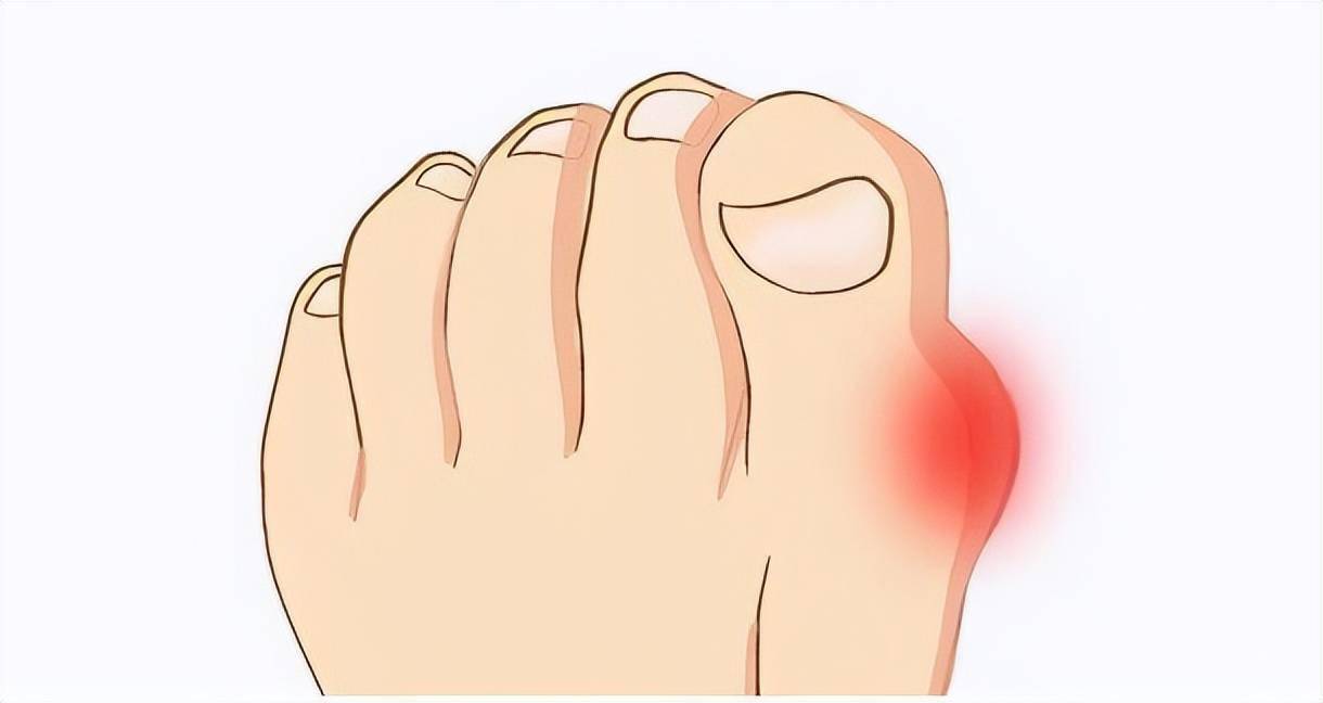 痛风不发作就是病好了?提醒:痛风分为5个阶段,看看你在哪一个