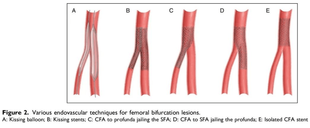 资讯速递股总动脉supera支架的应用早期经验与临床思考