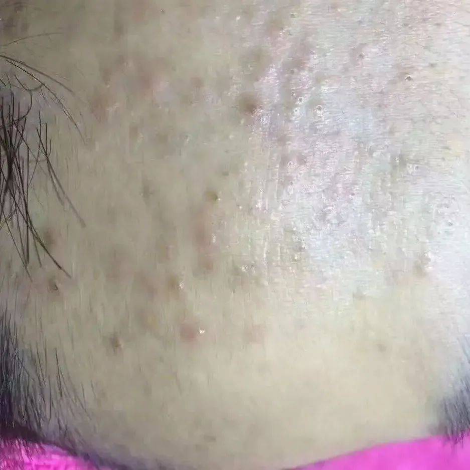 闭合性粉刺产生的原因_皮肤_祛痘_肌肤