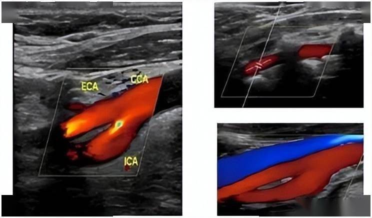 颈动脉超声报告单图片图片