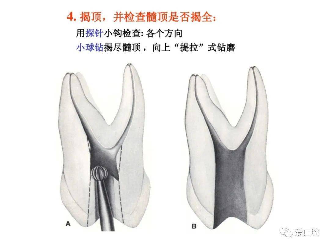 上颌侧切牙开髓位置图片