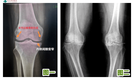 关节边缘骨质增生(图一),严重者出现膝内翻畸形,也就是o型腿(图二)