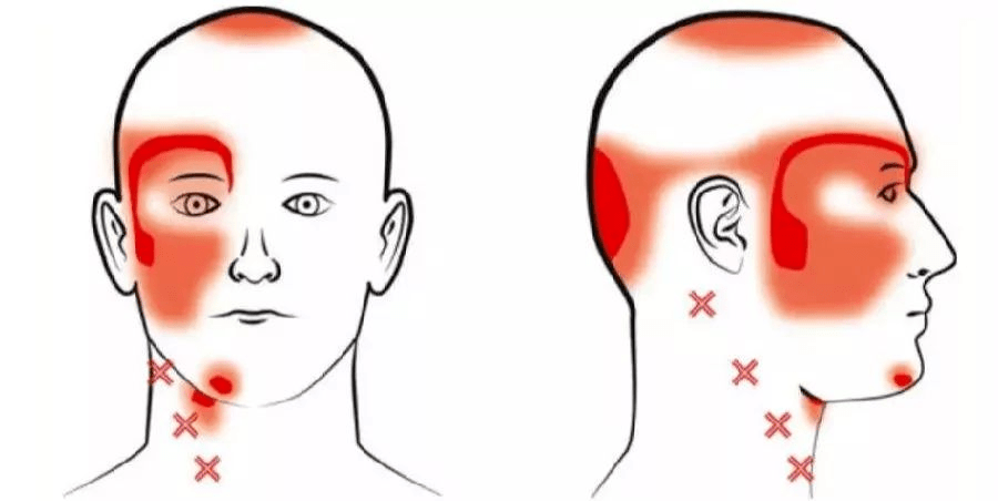 侧或双侧后脑勺,耳后闷胀或酸痛,甚至可以扩散至前额,颞部,顶部,颈部