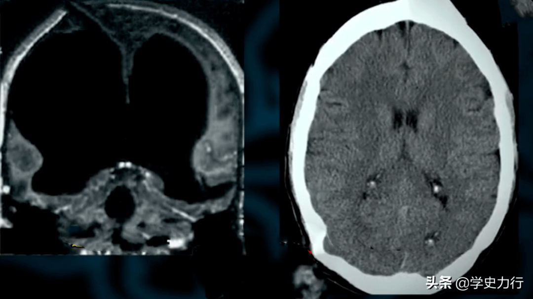 英国大学生头疼就医，医生给他脑部CT后惊呆了，他竟然没有大脑……