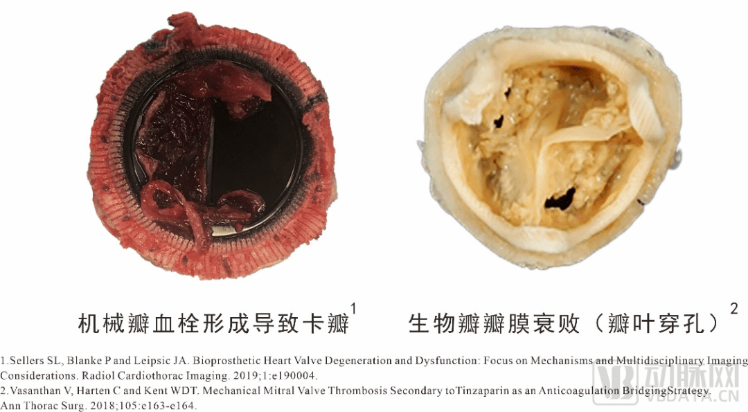 首发高分子瓣膜企业心锐医疗完成超千万元天使轮融资北极光创投独家