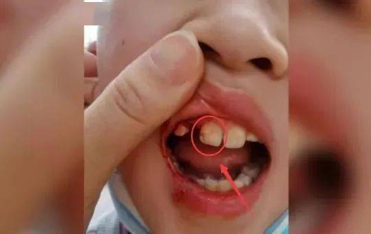 惊心陕西8岁娃在游乐场摔倒磕掉牙齿家长质疑景区安全设施有问题