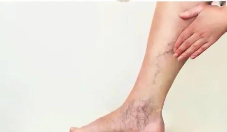 腿部青筋暴起小心烂腿一双袜子能解决的问题千万别拖到手术治疗