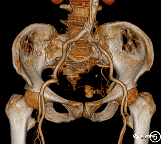 罕少见丨膀胱副神经节瘤合并动脉瘤