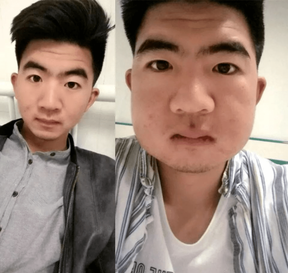 1 正确诊断 正确掌握拔除智齿的适应证,尤其是因为非特异性疼痛考虑