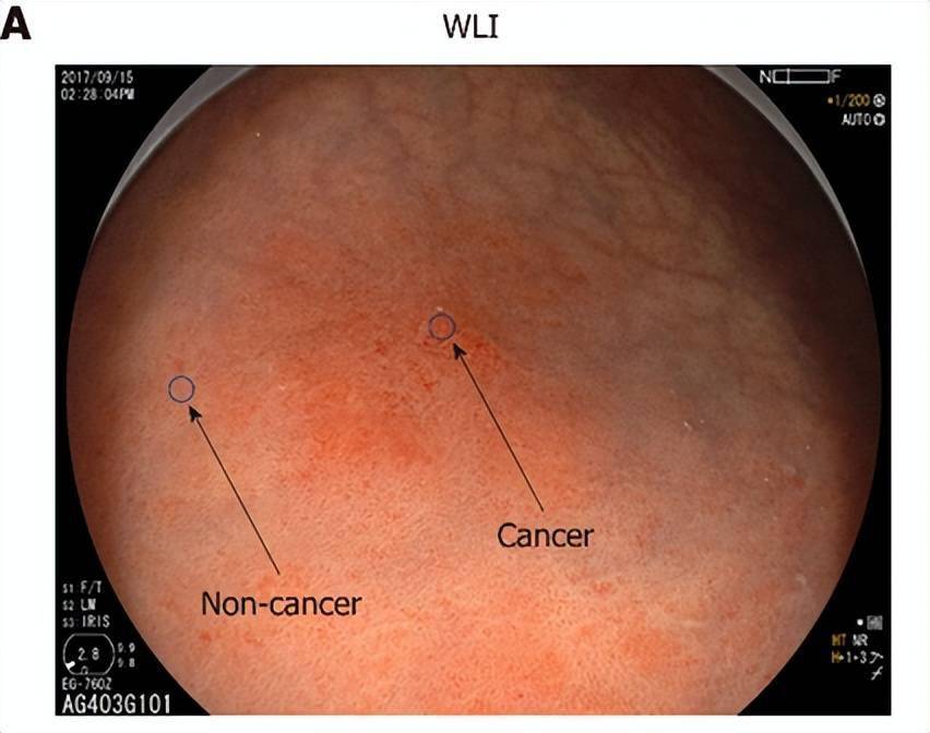 慢性胃炎,不典型增生,幽门螺旋杆菌感染等,而这些,都可以用胃镜进行
