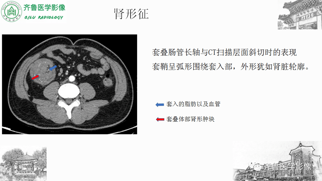 腸套疊影像診斷_文章_平臺_解剖