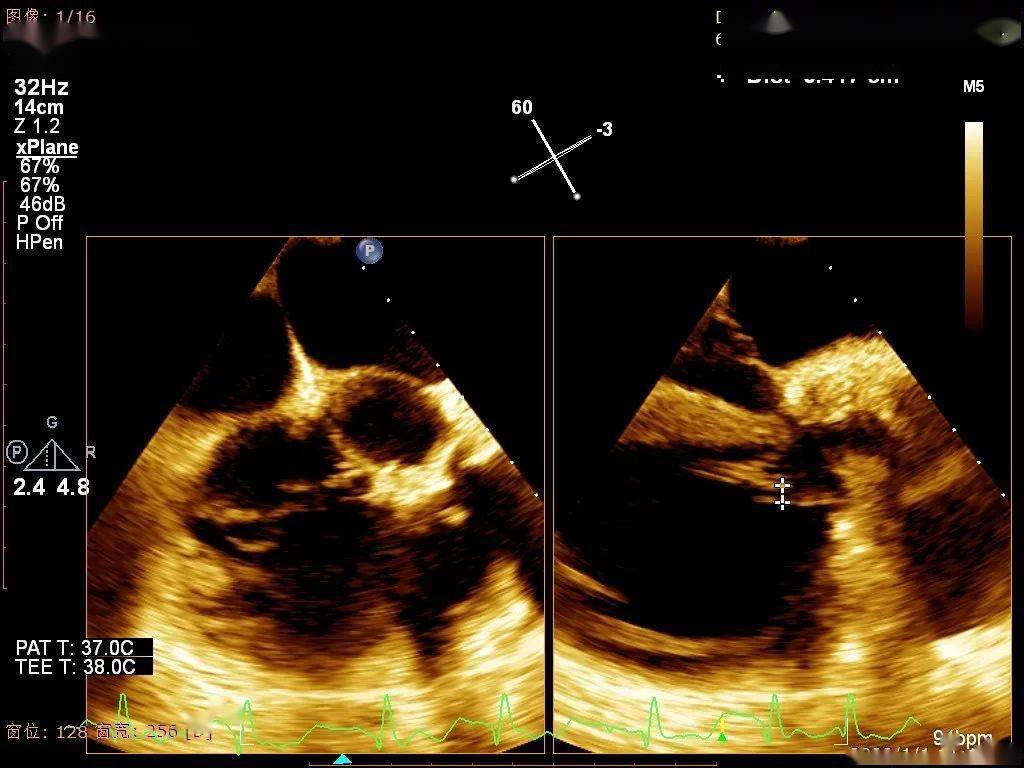 超声确认三尖瓣隔叶活动受限,增加了瓣叶间gap,测量得前隔反流处gap 4