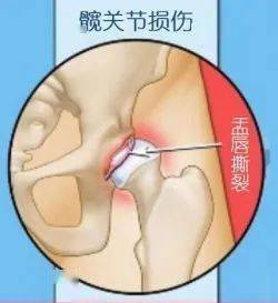 髋关节盂唇位置图片图片