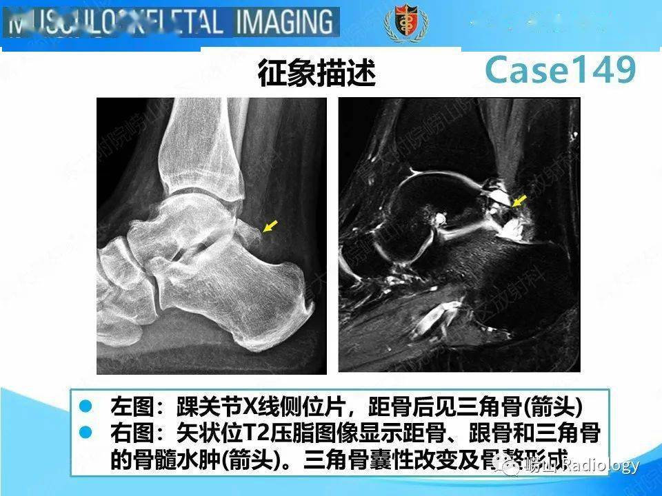 三角骨的位置图片图片