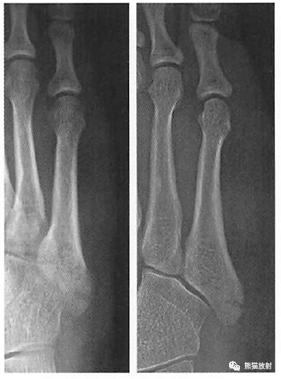 第五跖骨基底部骨折示意图,骨折线与骨干纵轴线不平行,几乎垂直,有别