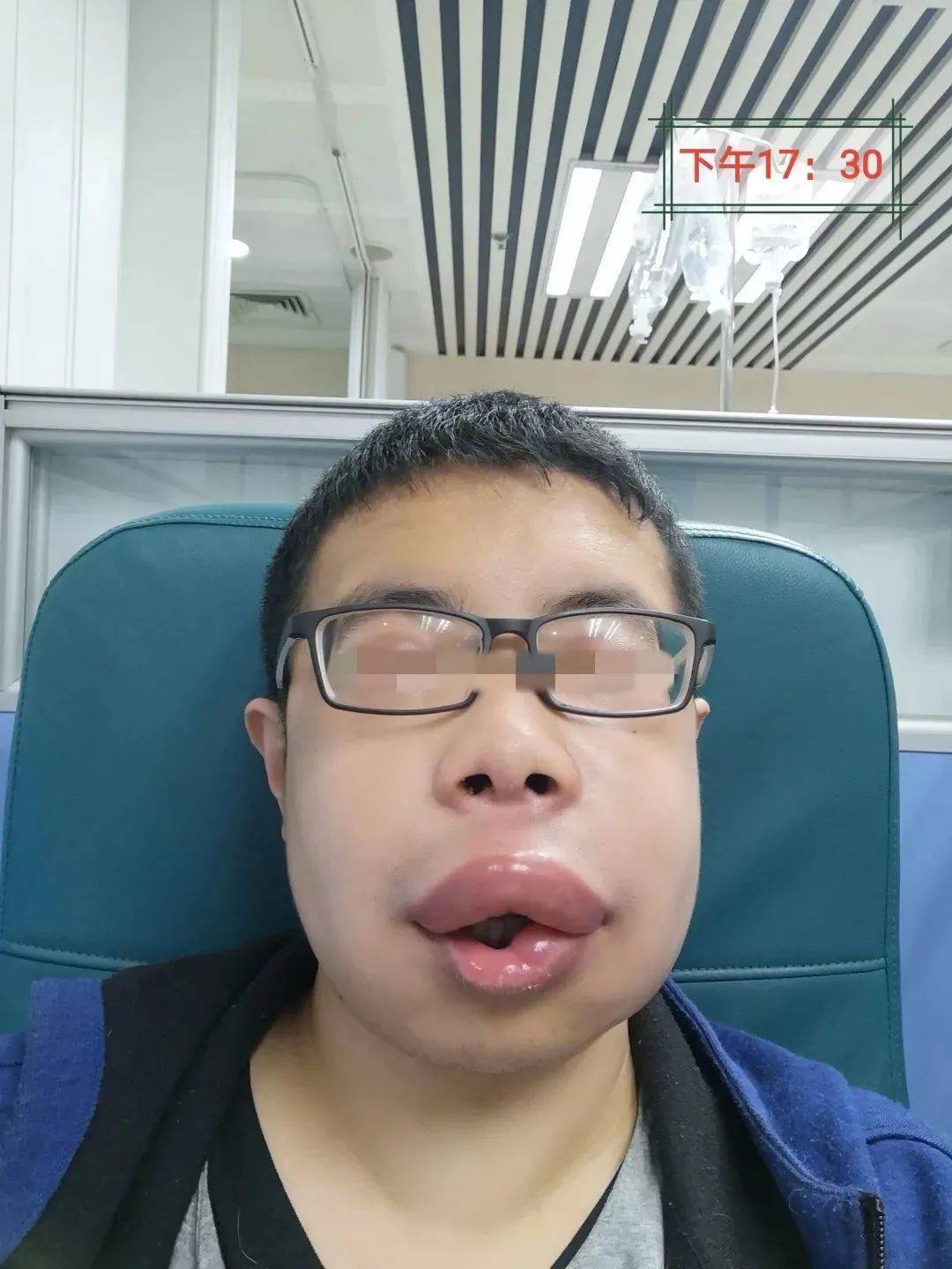 肿可致命近20万潜伏患者却不知情