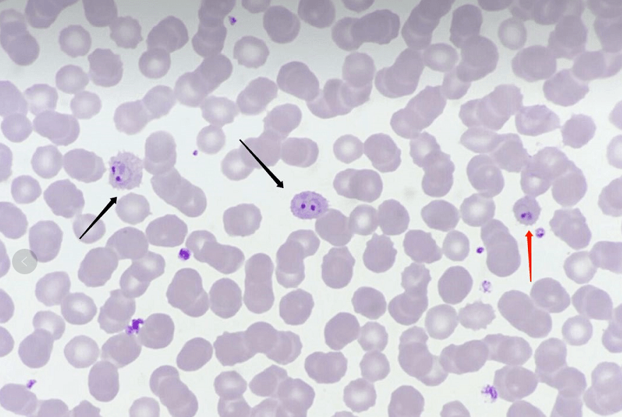 疟原虫血涂片染色图片