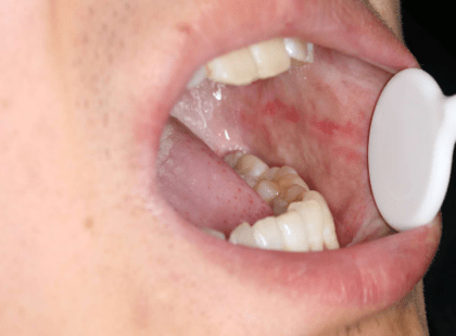 某人经常吃槟榔,这是他的口腔黏膜发生的变化