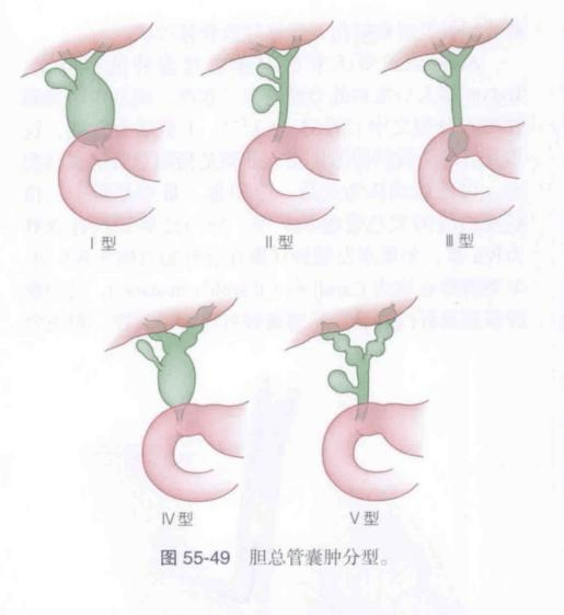 胆总管囊肿是小儿常见的胆道系统畸形病变,常见症状是腹痛,腹部肿物和