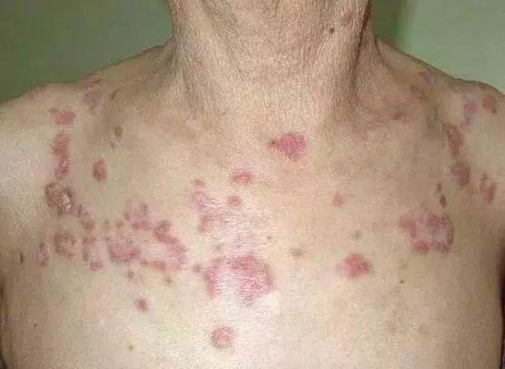 往轻里说可能是普通的皮炎,湿疹,重一点可能比较严2,皮肤红斑病情