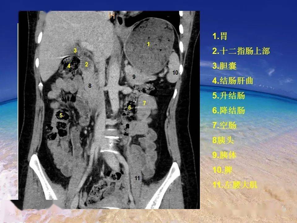 消化道穿孔ct影像大汇总看完印象深刻