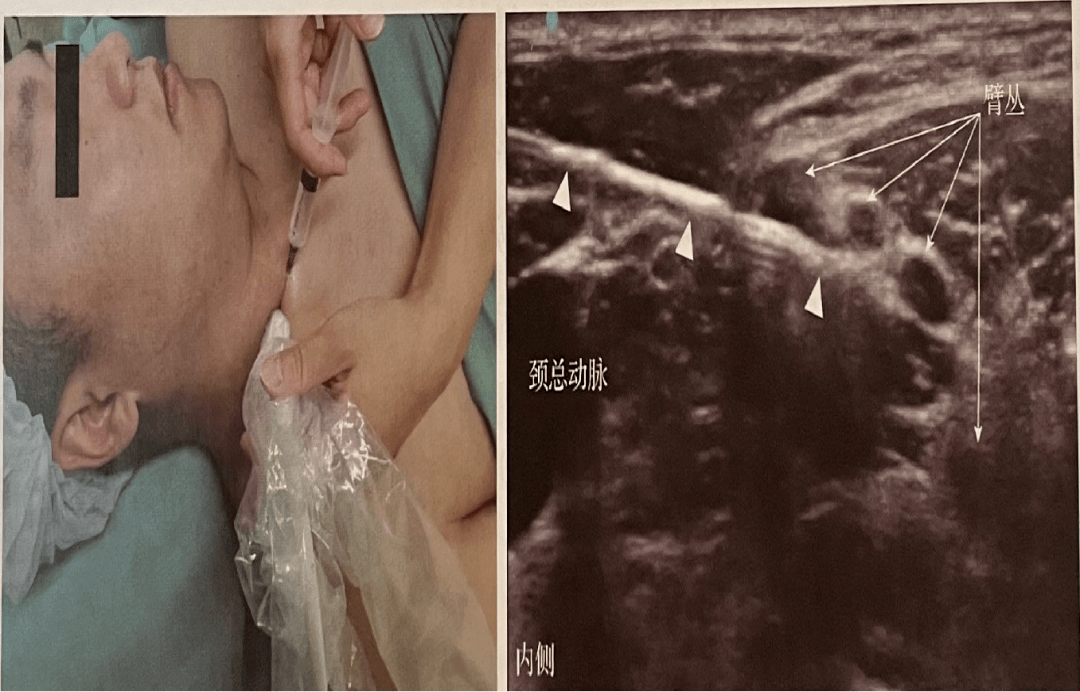 神经阻滞丨超声引导下臂丛神经阻滞