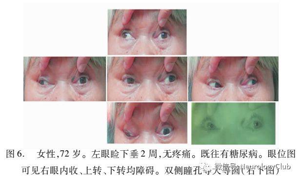 动眼神经麻痹的诊断及处理原则_恩比德眼眶骨折轻微脑震荡_瞳孔_患者
