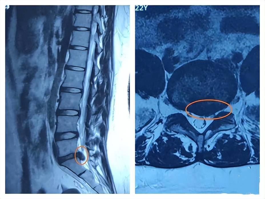 花季女孩腰椎如花甲老人行走困难竟是因为葛优躺