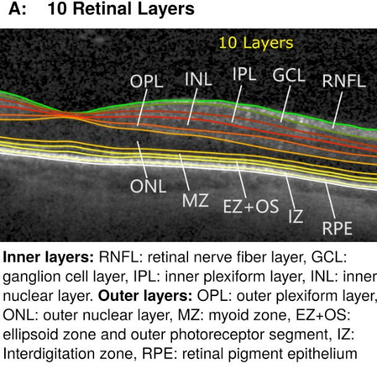 視網膜的十層近期抑鬱狀態和各層視網膜厚度的相關性小結:10層視網膜