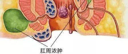 肛瘘为什么难治愈?最佳的治疗方法是什么?可以不做手术吗？