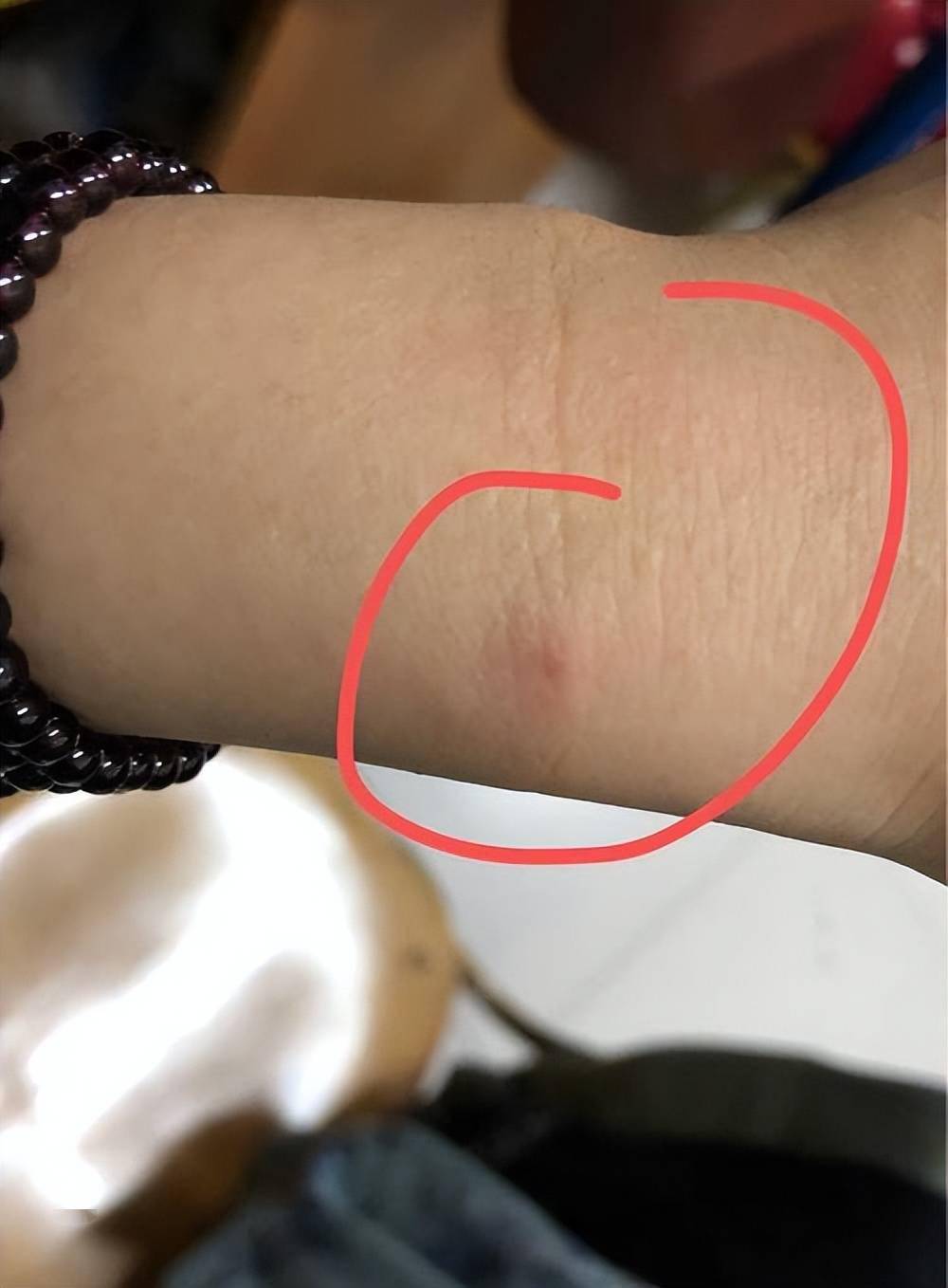 为什么有的人吃桃子会过敏哪些人不适合吃一文为你讲明白