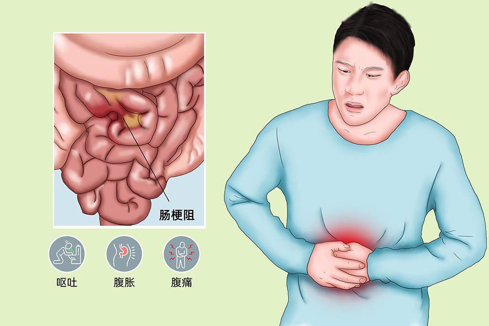 不能耽擱,但是因80歲高齡,且2年前有直腸癌手術史,治療風險高,醫生