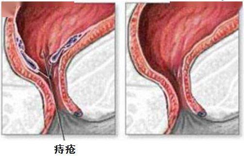 痔疮内疮图片图片