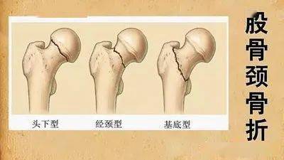 股骨颈骨折位置图片图片