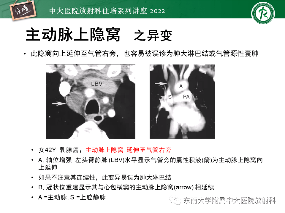 心包隐窝的ct解剖