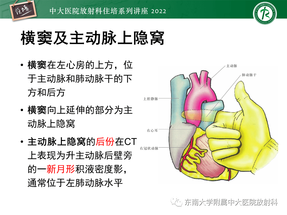 心包隐窝的ct解剖