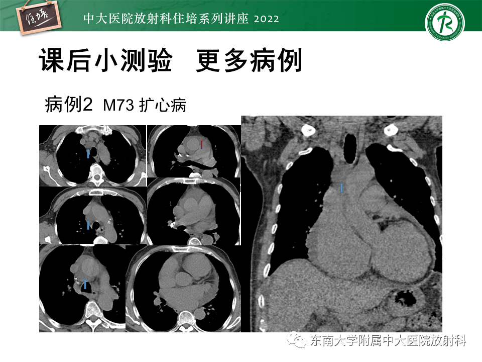 心包隐窝的ct解剖