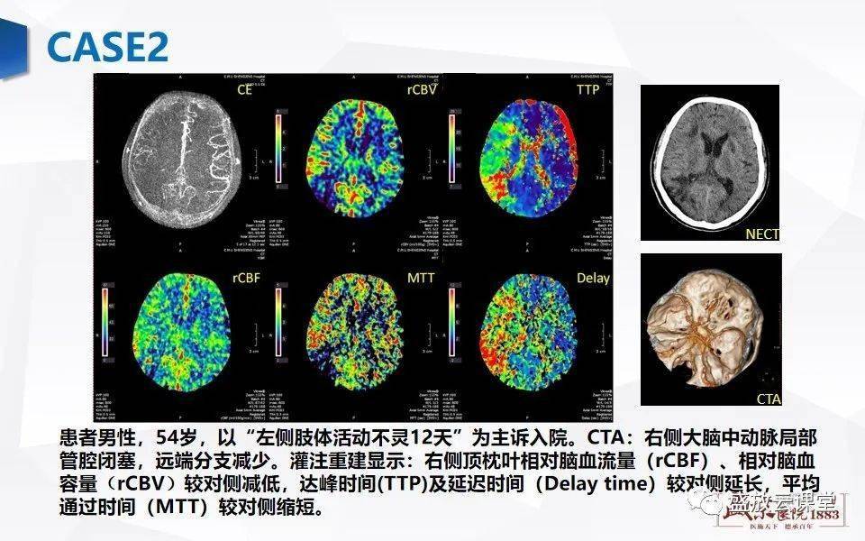 ct灌注成像图像解读图片