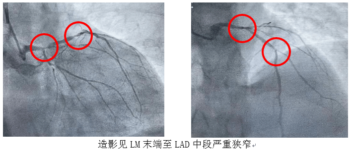 左主幹病變是十分高危的病變,必須保證左主幹以及前降支,迴旋支的血流