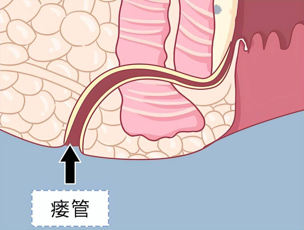 肛瘘卡通图片