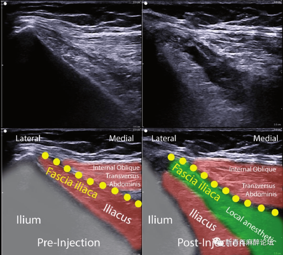 神经阻滞丨超声引导下腰丛及其分支神经阻滞