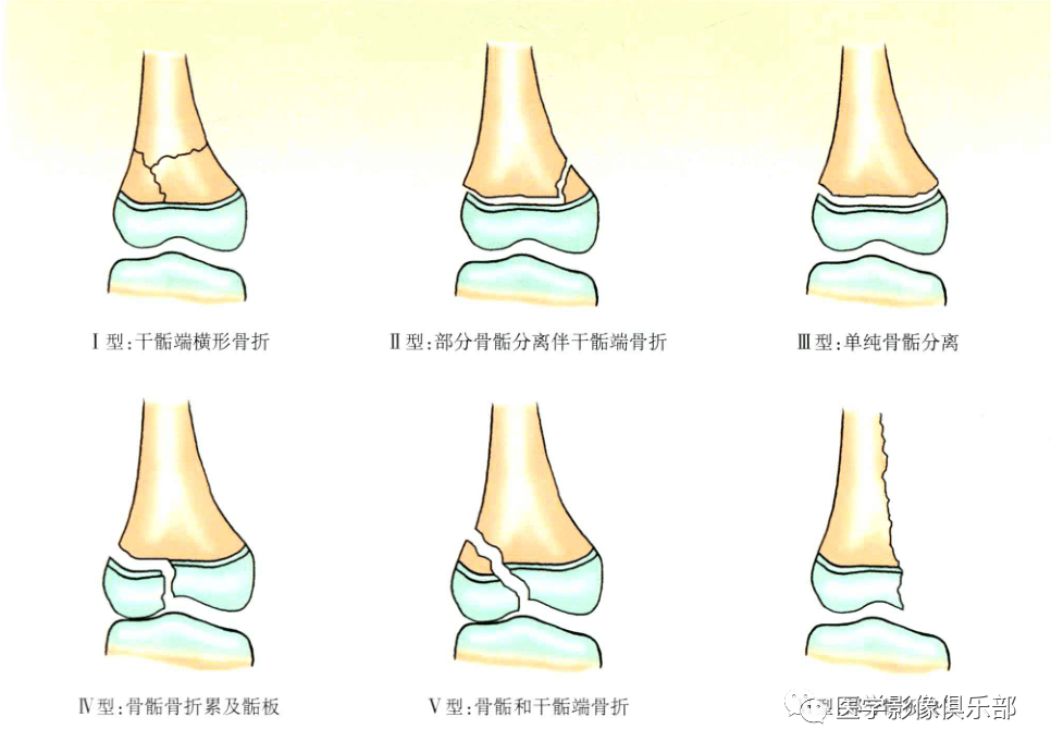 骺板间隙图片