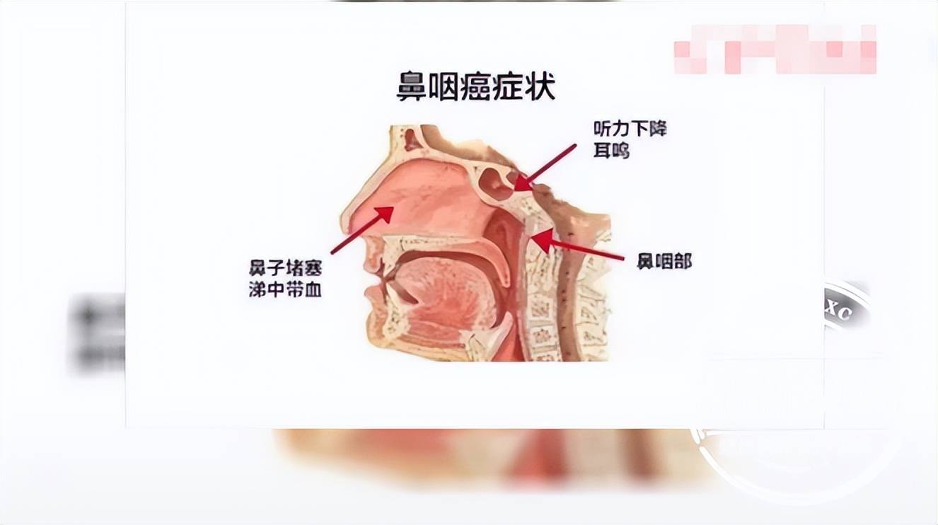 网传鼻咽癌在广东,广西,湖北等省份发病率较高,是因为当地人喜欢吃
