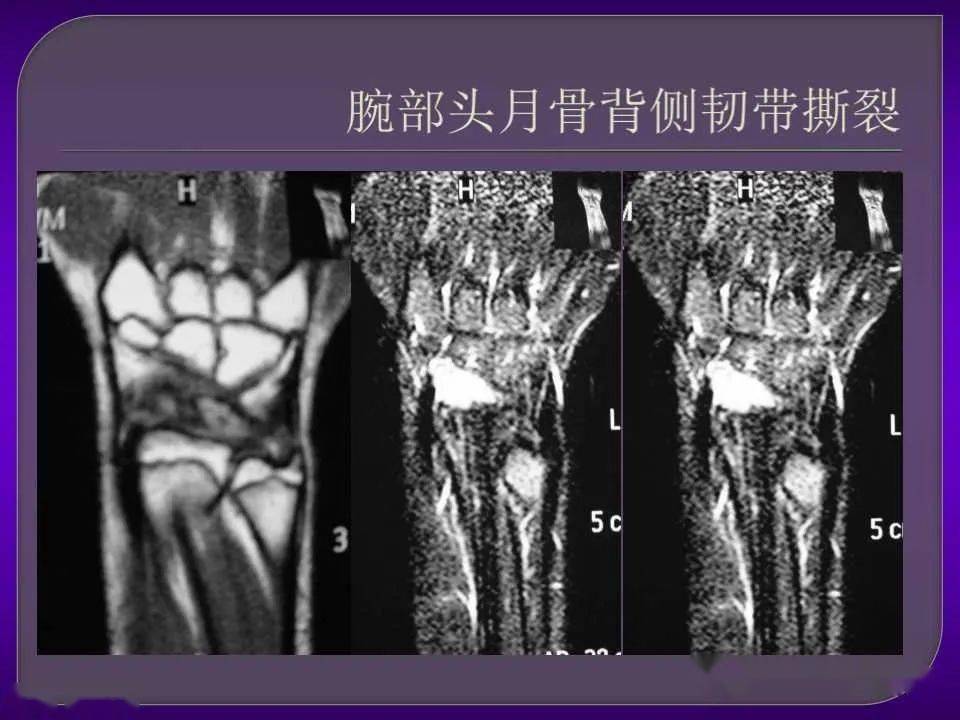 詳細篇腕關節解剖及常見病變mri表現