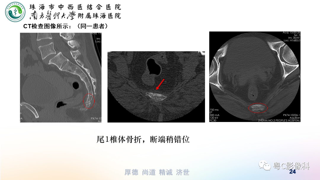 骶尾椎侧位图片