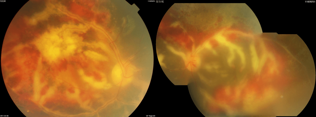 经过仔细检查，发现孩子眼底出现了严重的病变。在上边这幅眼底图中，我